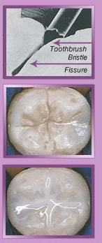 Tooth Sealants