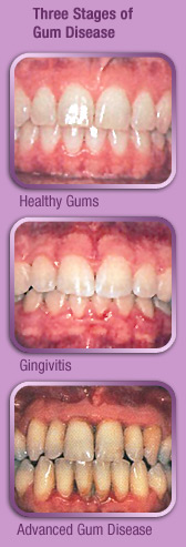 Gum Disease